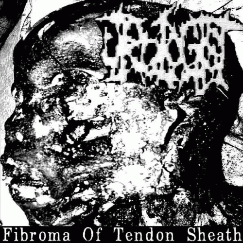 Fibroma of Tendon Sheath